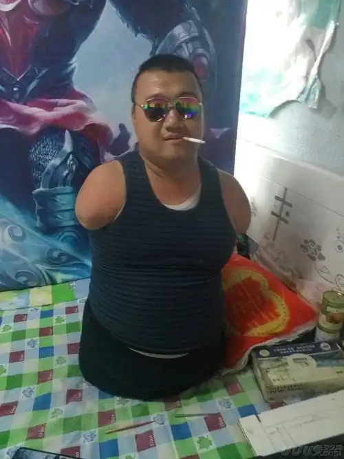 往期回顾--海豹肢症 海豹人的苦与乐海豹肢症,一种罕见的先天性畸形