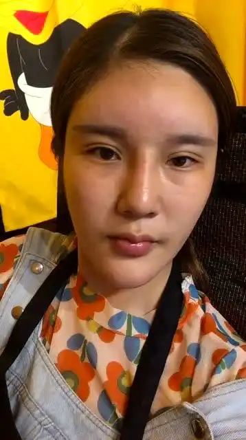美女网红整容后遗症,这个额头没法看,感觉像土地爷爷