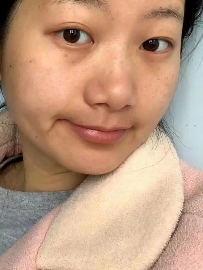 额头下巴,暗沉还夹杂着痘印和闭口脸色黄的简直像是一个黄脸婆之前用