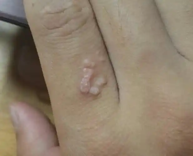 扁平疣前期图片