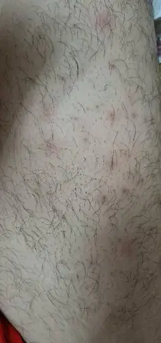 请问我的大腿上的这些大红点是毛孔堵塞还是什么的?