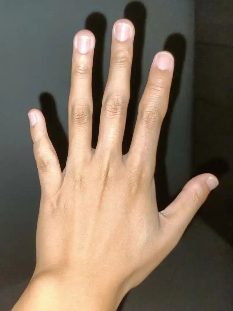 有无人来交流一下短指症 从小大拇指指甲很短,小拇指在小学的时候发现