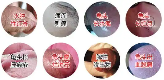 健民泌尿专家全方位解析龟头炎-中山健民医院