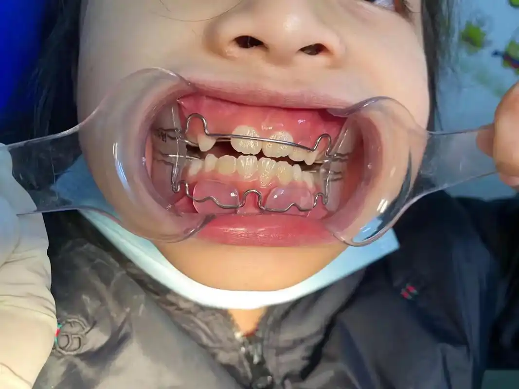 儿童早期矫正早发现早治疗避免二次固定矫正拔牙机率 - 抖音
