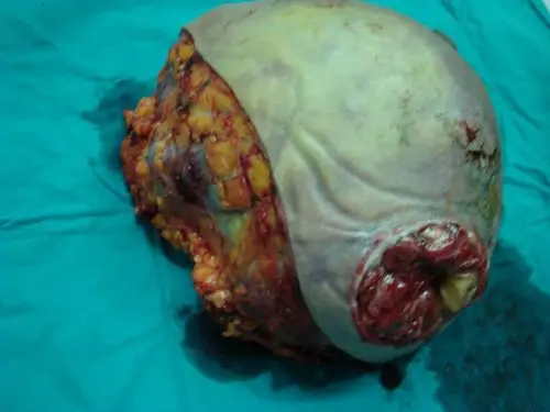 乳腺罕见肿瘤(附图片)结果及图片已更新!