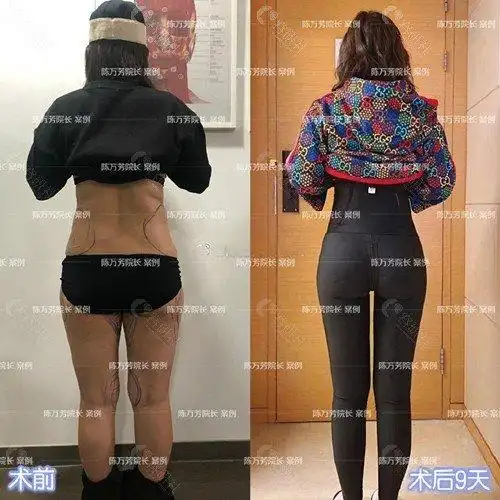 北京联合丽格陈万芳吸脂案例前后对比   图源www.rongyanshe.com