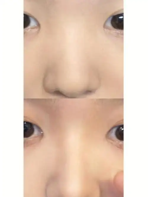 塌鼻梁鼻翼大的姐妹试试这样修
