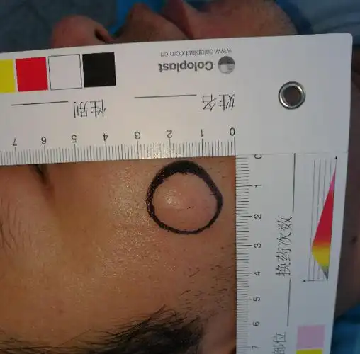 表皮囊肿是什么