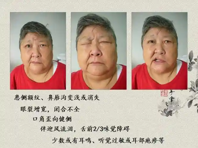 面神经炎面瘫的针灸康复治疗思路ppt