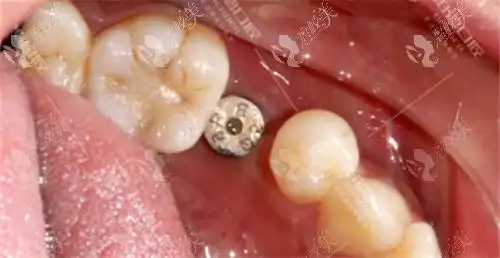 广州柏德口腔种植牙怎么样看完顾客评价跟真人实例就明了