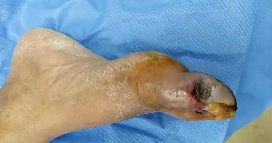 血糖高了,看脚就知道?脚部若有这3种变化,提醒你该降糖了