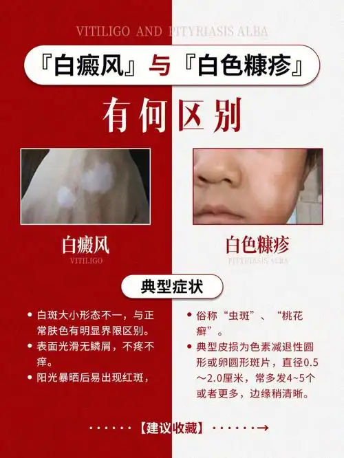 孩子脸上总有白斑,是虫斑还是白癜风71