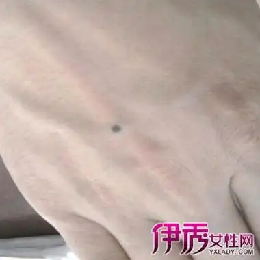 【图】左手背上长痣图解详情 痣相算命运情大详解