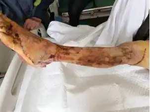 争分夺秒的200公里,只为保住被宣判截肢的腿!