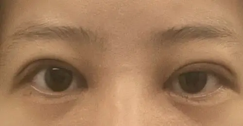 看看我双眼皮提肌是不是失败了福州协和谢义德