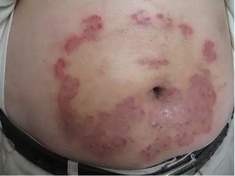 体癣是由哪些方面的原因导致的