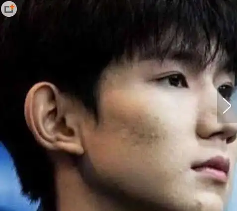 原创王源的脸怎么了近来多次被拍到脸上坑坑洼洼