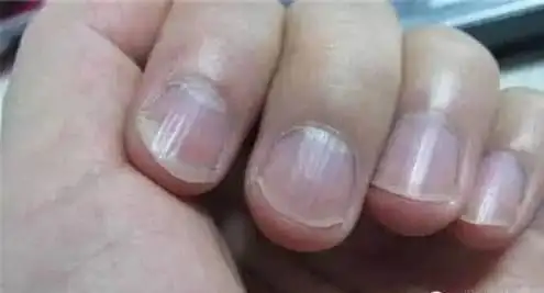 指甲上出现这些竖纹,青紫色竟是大病预兆!体内器官的慢性病变了!