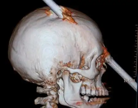 巴西男子铁棍刺穿头颅 手术后奇迹幸存(组图)(1)_科技频道_光明网