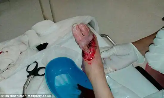 医生担心不得不截肢,但在两场手术后,成功挽救了这只脚.