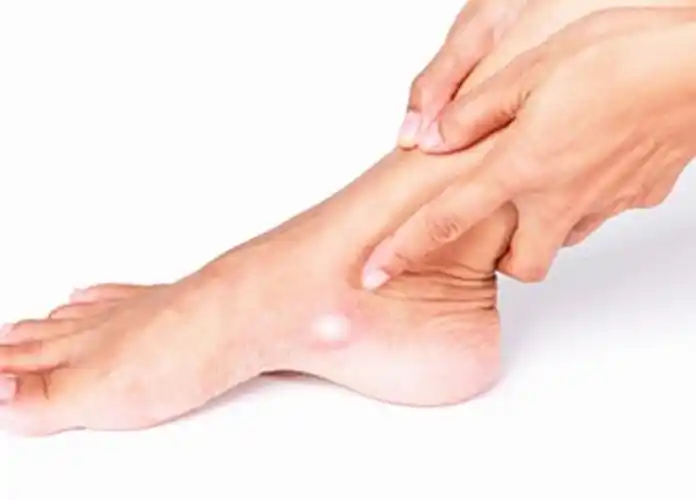 走多了就疼,脚上长了个硬疙瘩,什么是副舟骨综合征?