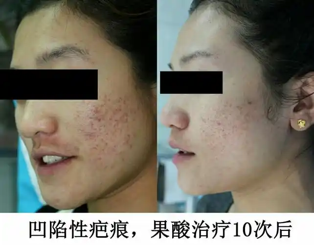 临沧市第二人民医院皮肤科果酸换肤术