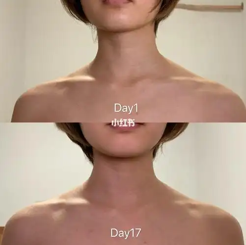 day1782消灭斜方肌对比图