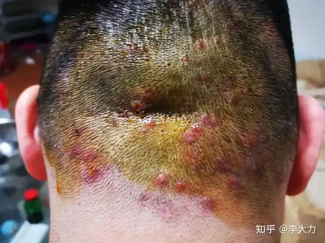 阴虱不是什么治不好的 不用太过紧张,按照上文说的做即可.