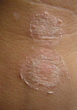 体股癣初期现象图片8