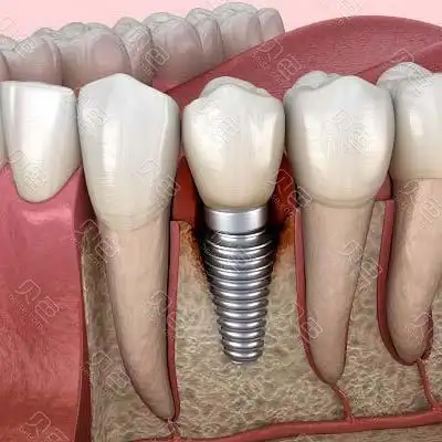 这几个种植牙失败的前兆要警惕! - 贝色口腔