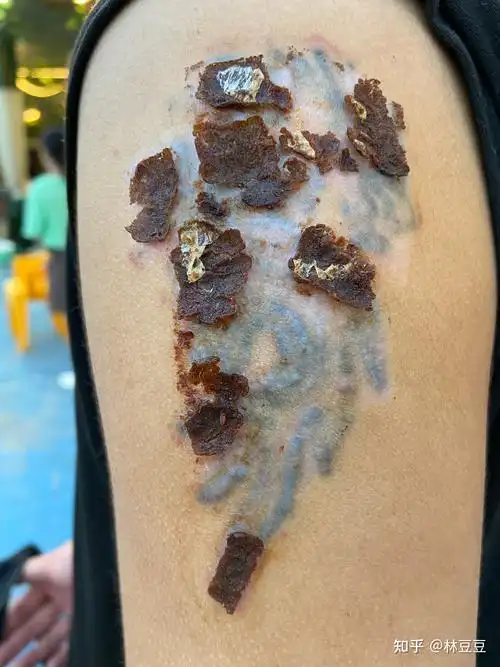 洗纹身恢复过程 - 知乎