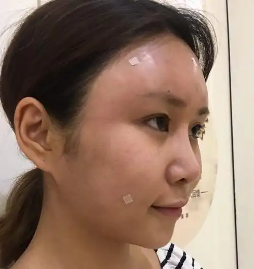 日记本自体脂肪面部填充案例对比图