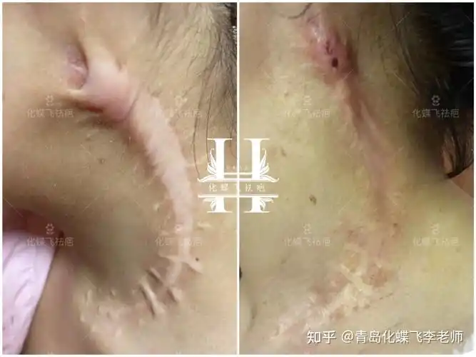 非常严重的手术增生疤痕