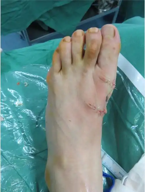 拇外翻_手术_治疗方法_治疗方式 - 好大夫在线