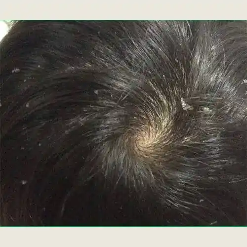 头皮_去屑_头发