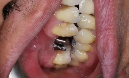 两颗种植牙种歪的病例补救