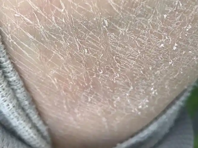 到冬天皮肤就干燥成这样怎么回事??_百度知道