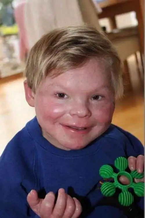 「长不大的男孩」13岁长得像3岁