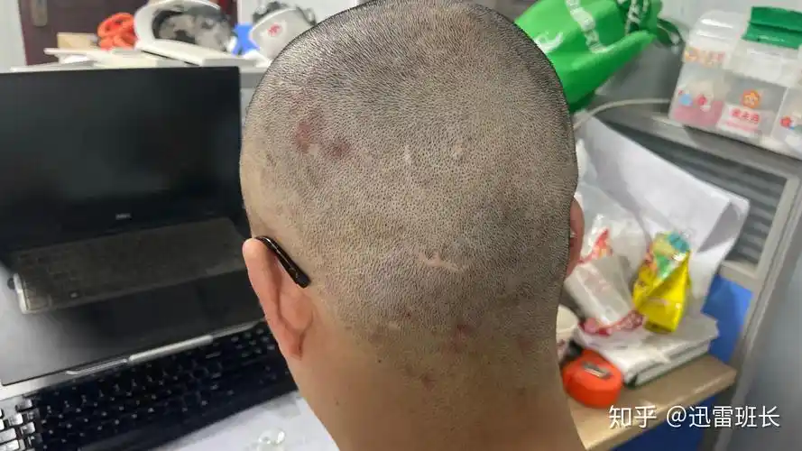 见过的最大头皮屑多大