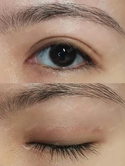 做完平扇双眼皮5个月了,还算成功吗