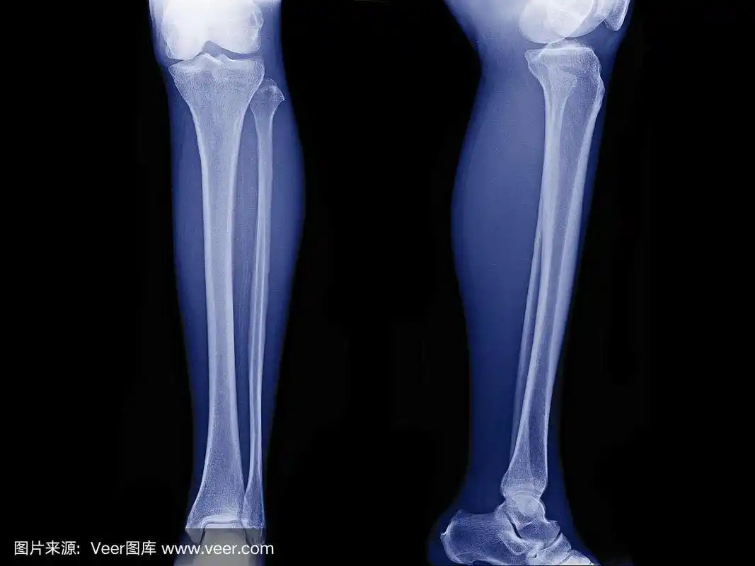 成人正常腿骨x线片,小腿正面,侧视图