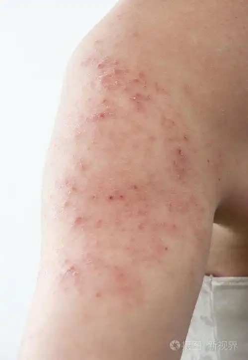 过敏性皮疹皮炎