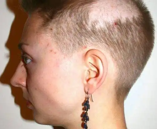 从她十岁那年开始,就得了一种怪病叫作拔毛癖,在