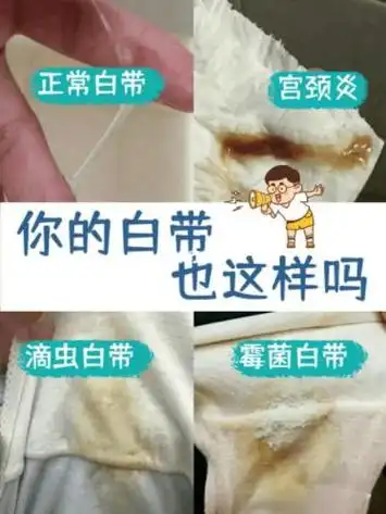 正常白带是什么样子的真实图片女性下面白带异常各种症状图片大全