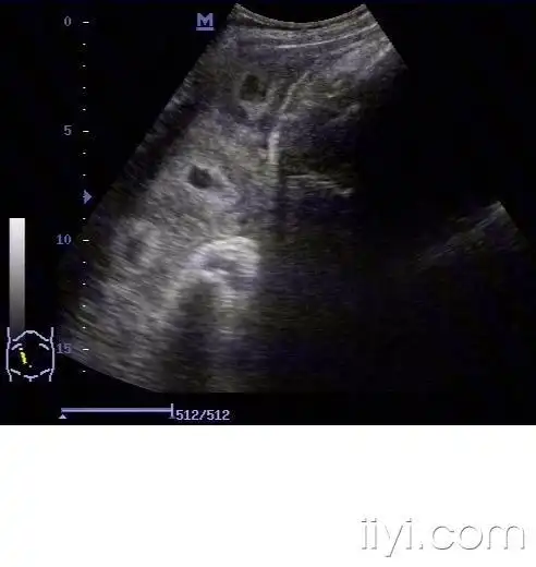 【分享】少见的胎盘血窦!