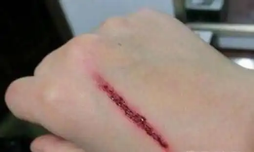 加速伤口愈合的小妙招