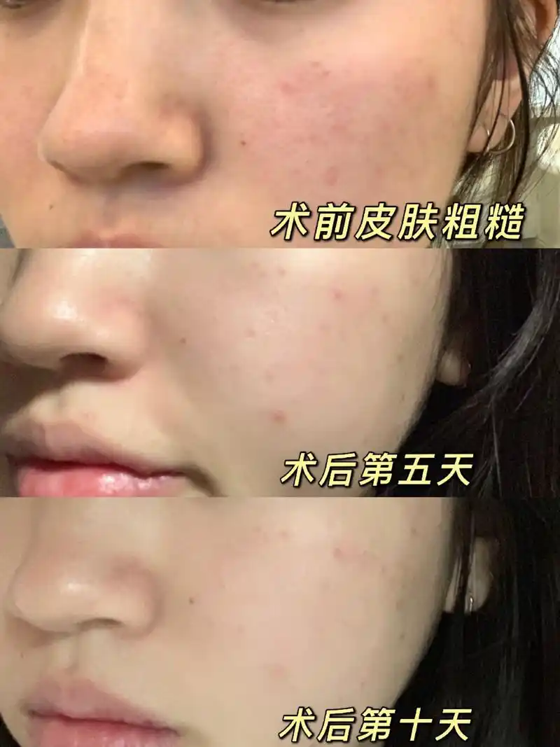 薇美芙虾青素&光子嫩肤 | 术后十天反馈