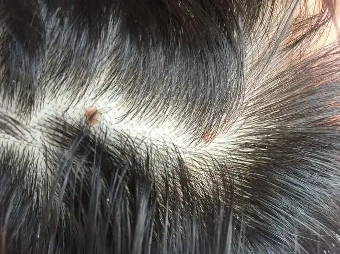 头皮上起红点这是啥?有图