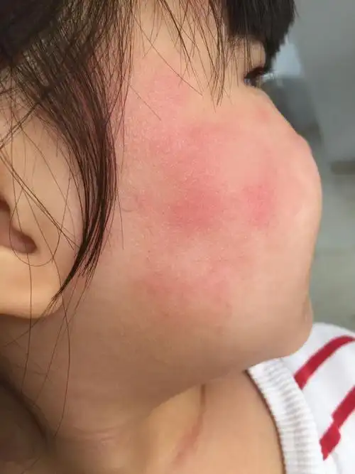 孩子两个脸蛋,皮肤褶皱处长了很多红疙瘩,皮肤还皱皱的干干的感觉,痒
