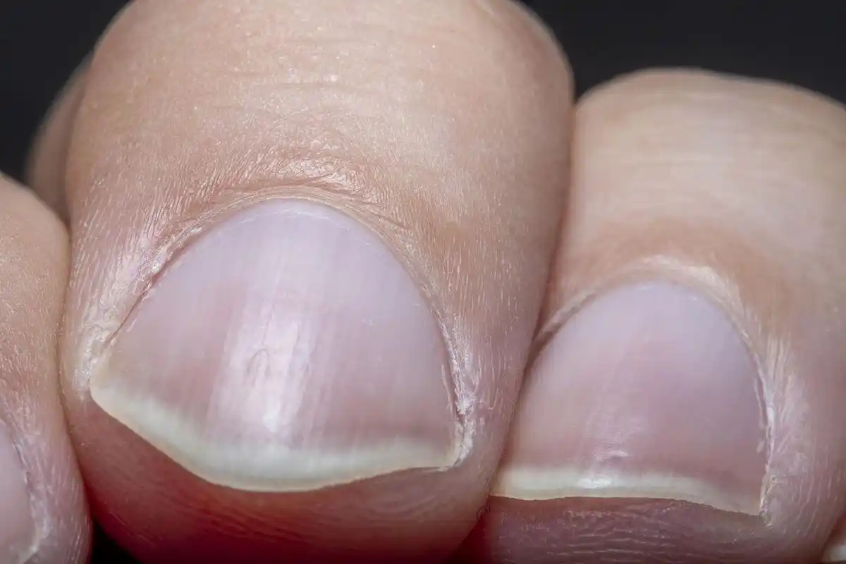 手指甲出现竖纹:原因与对策 手指甲是身体健康的晴雨表,它们的状态